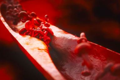 Atherosclerosis