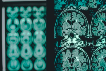 Alzheimer's Disease