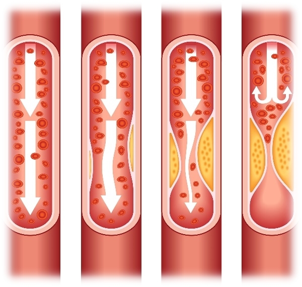 Lipidomics for Cancer Research